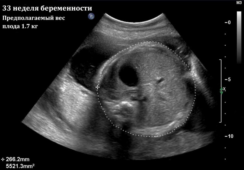 Гипотрофия плода при беременности