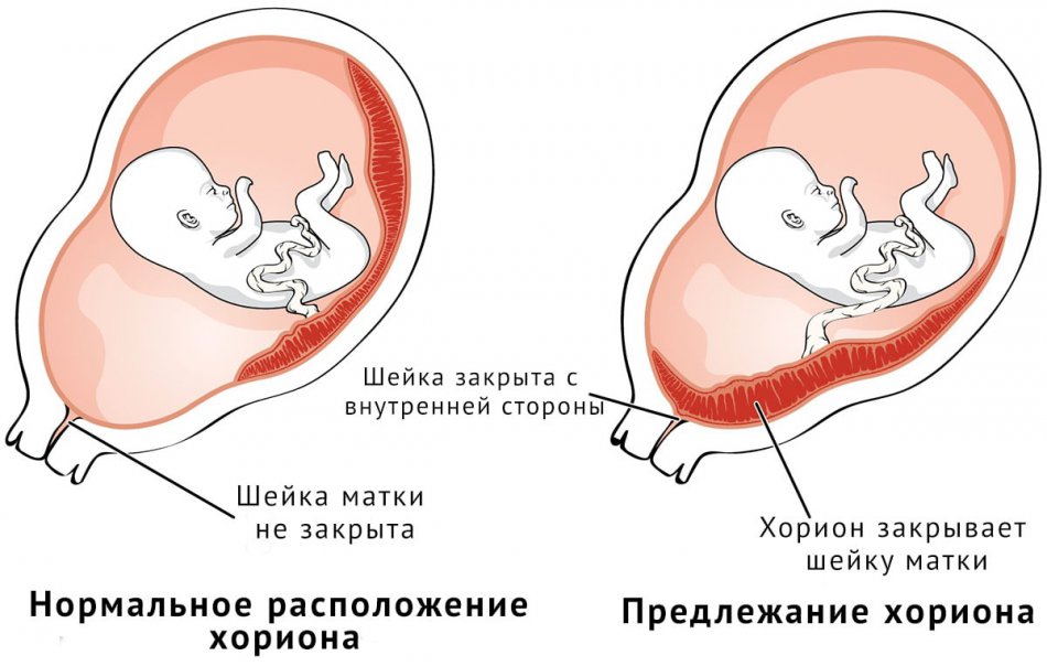 Предлежание хориона