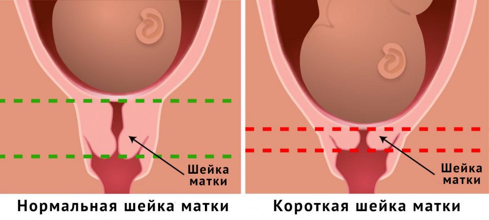 Короткая шейка матки при беременности