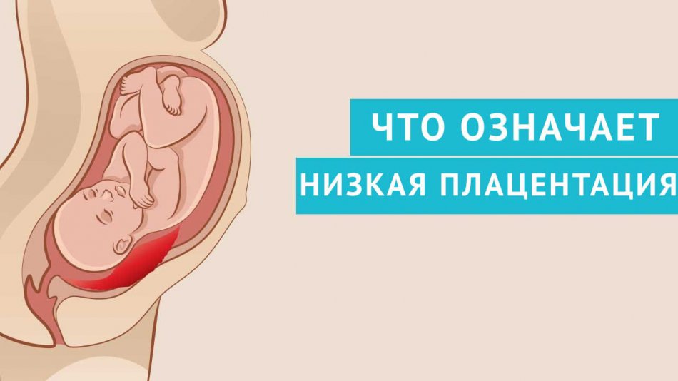Низкая плацентация при беременности