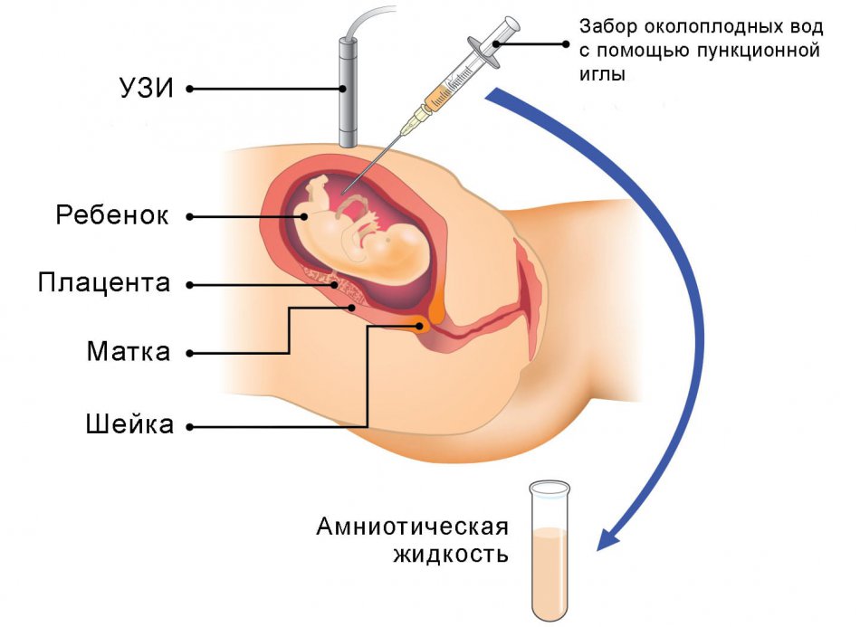 Амниоцентез при беременности