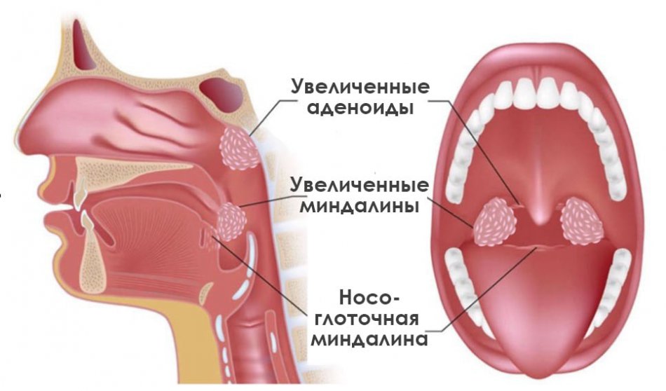 Аденоидит у детей