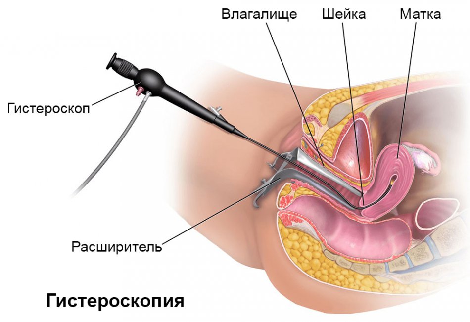 Что такое гистероскопия матки?