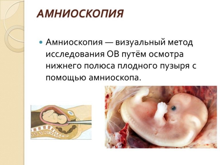 Амниоскопия